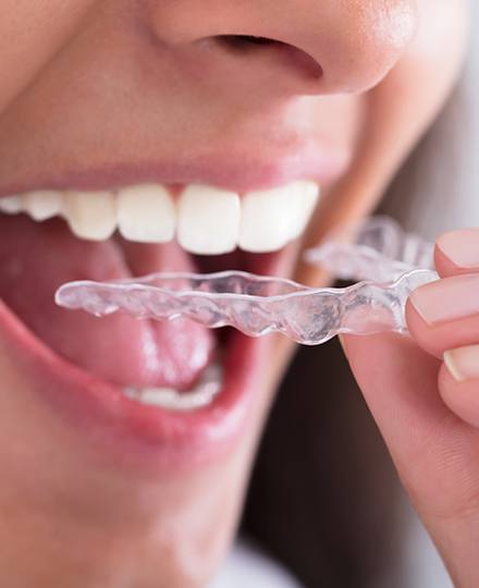 Patient placing Invisalign clear braces tray