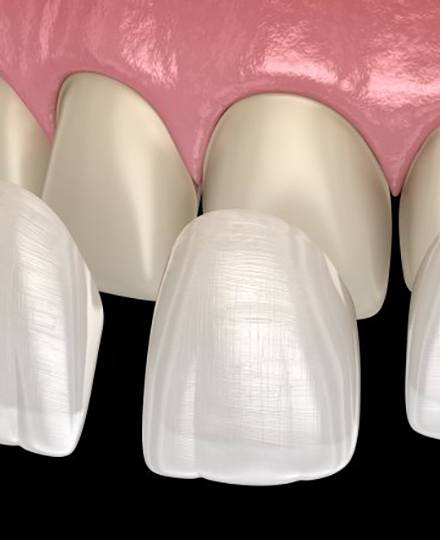 model of several veneers being placed over a patient’s upper front teeth